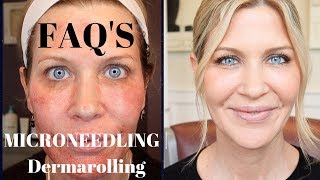 Microneedling  Dermarolling QampA  Before During and After Pics [upl. by Beyer]