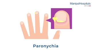 What is Paronychia and Its Treatment  Manipal Hospitals India [upl. by Northway]