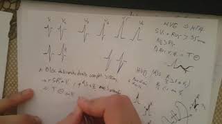 formation ECG  20 bloc de branche droit et gauche [upl. by Zaria]