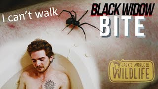 Black Widow BITE Try To SURVIVE [upl. by Hartman978]